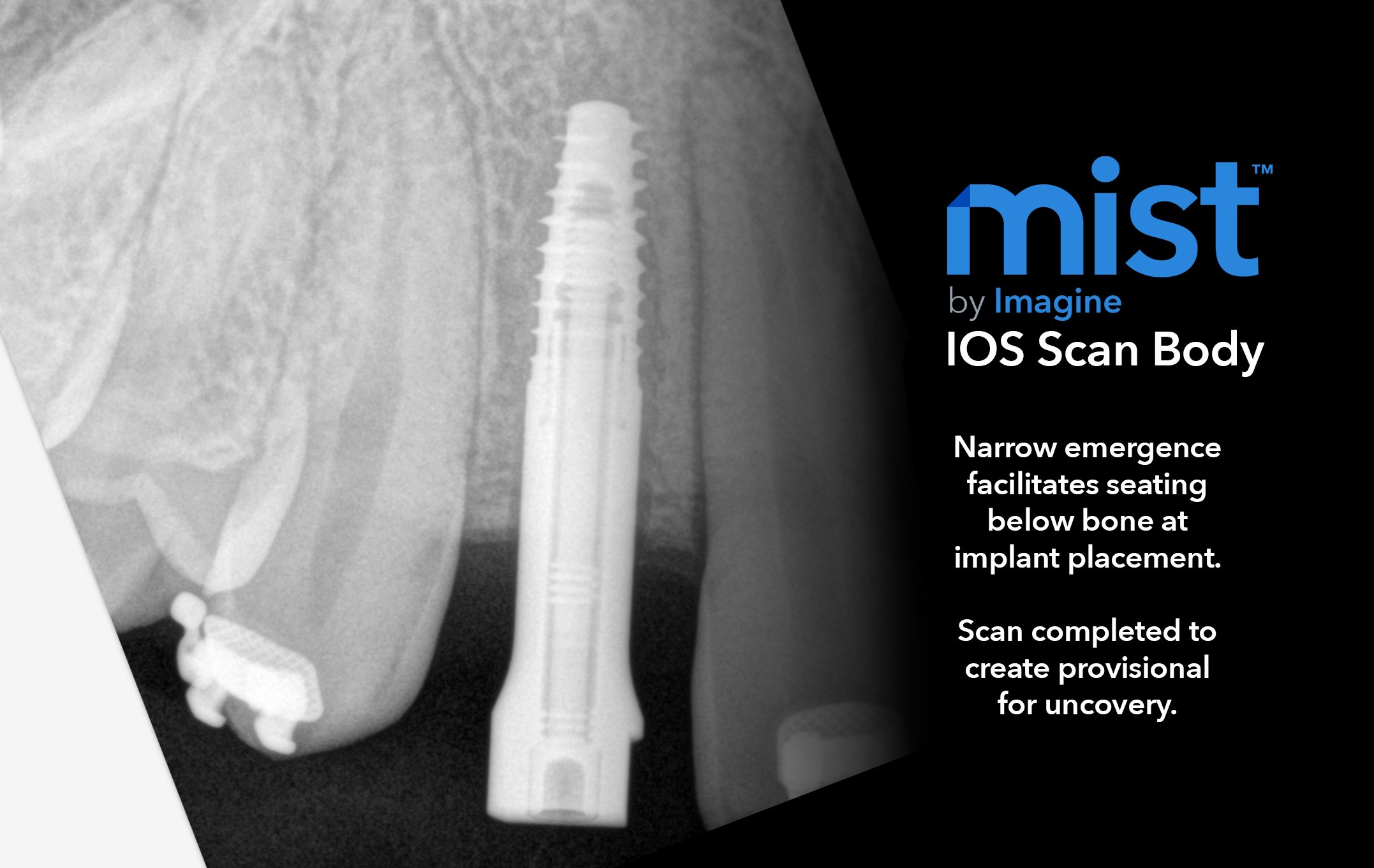 mist IOS Scan Bodies - for accurate seating & quick scanning.